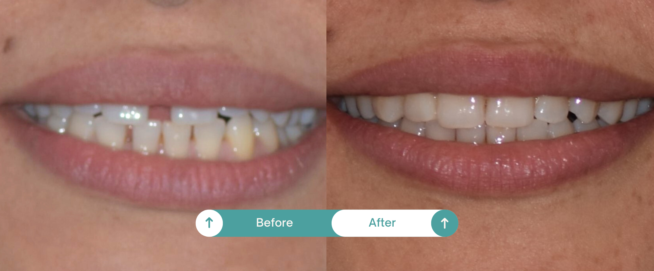 teeth-image-change-of-full-women